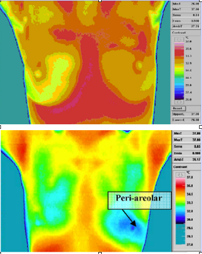 Comparison of normal and cancerous tissue under a infrared camera