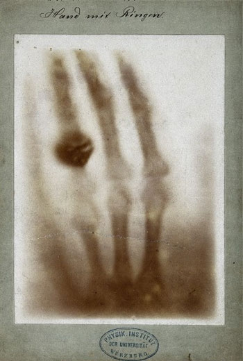 The hand with a ring: The world first x-ray photo taken by Rontgen. Courtesy of Google