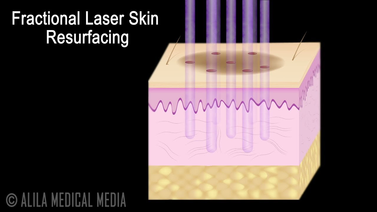 An animation of the laser beam penetrating the skin with a gradient of light. Courtesy of Alila Medical Media