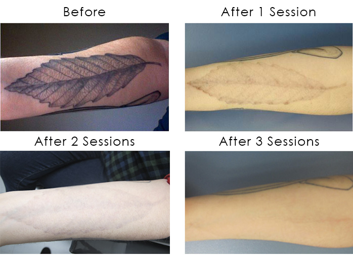 The process of laser tattoo removal over 3 sessions. Courtesy of Schweiger Dermatology Group