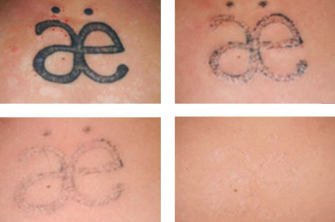 The process of a tattoo being removed through four sessions. Courtesy of the Cosmetic Skin & Laser Center