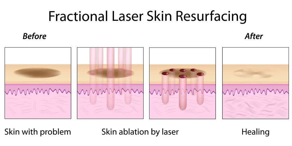 Laser resurfacing process