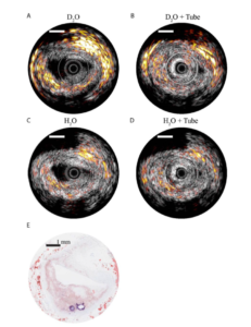 Intravascular Imaging: Photoacoustic and Ultrasound Catheters for Clinical Use