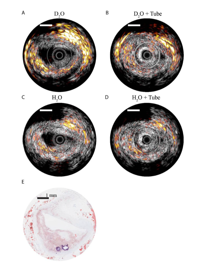 intravascular imaging- catheter data