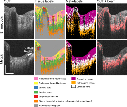 test results on normal and nearsighted eyes