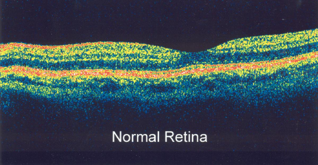 Lasers in ophthalmology: retina