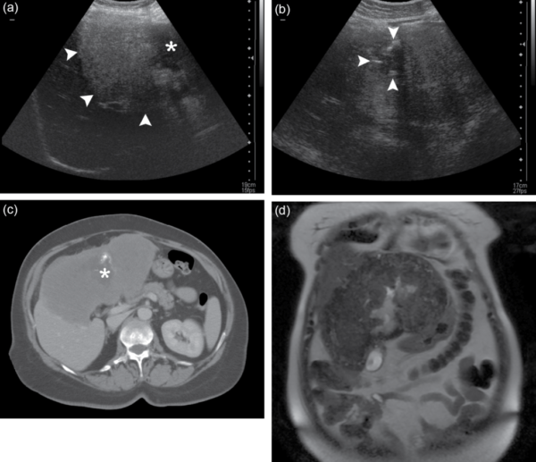 Optical Ultrasound High Potential to Change Surgical Guidance