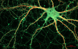 New Photon Counting Plugin Solves Image Problems in Neurology