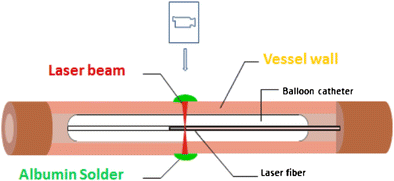 tissue welding using lasers and albumen solder