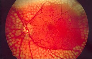 Case of diabetic retinopathy