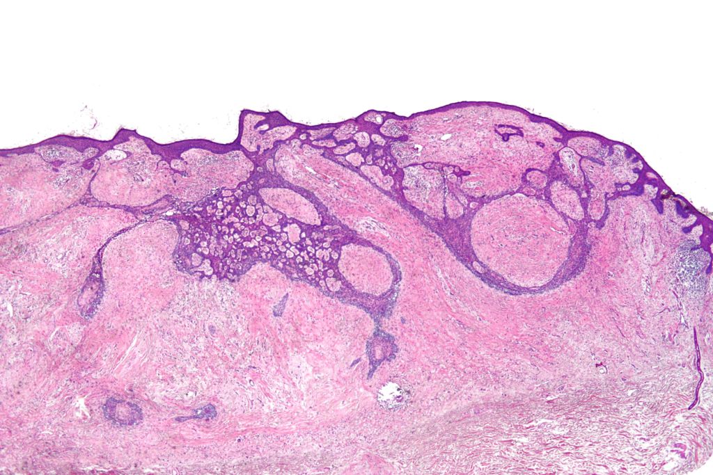 biophysical cancer analysis