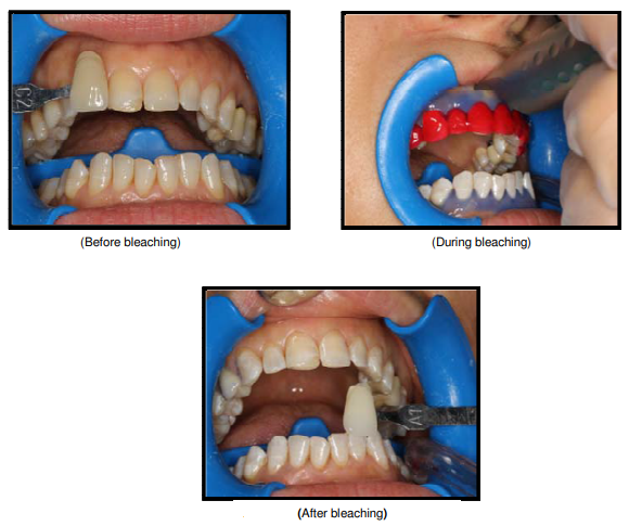 photobleaching using SSL