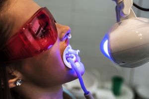 Photobleaching Using Lasers for Teeth Whitening in Dentistry