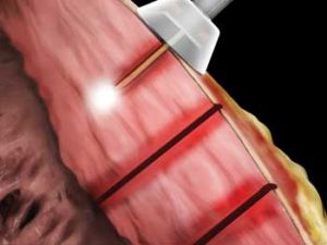 Transmyocardial Surgery: Using Lasers to Increase Vascular Flow