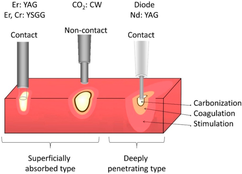 Power spread profile