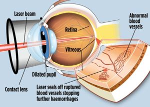 Photocoagulation Using Lasers for Treating Diabetic Retinopathy