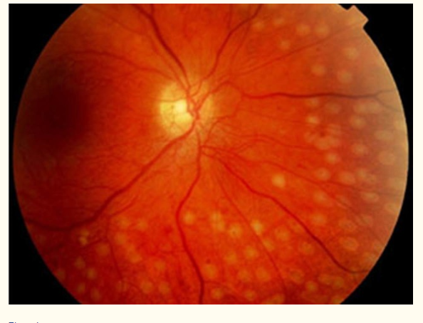 Results of coagulation