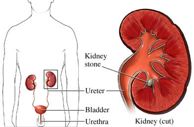 kidney stone