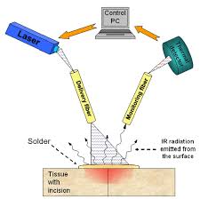 Tissue Welding Using Lasers for Sutureless Surgical Procedures