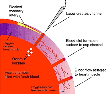 transmyocardial laser method