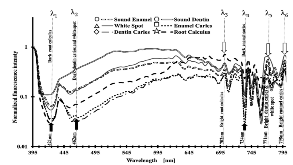 dental caries