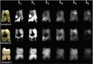 Dental Caries Diagnosis Using Fluorescence Imaging Techniques