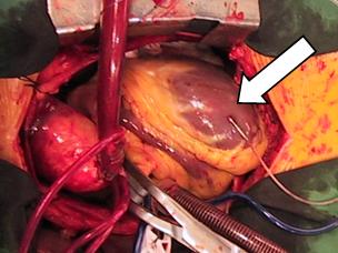 cardiac blood flow