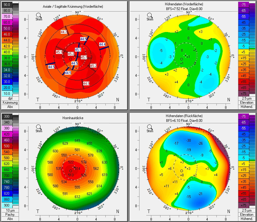 Laer Eye Surgery Mapping