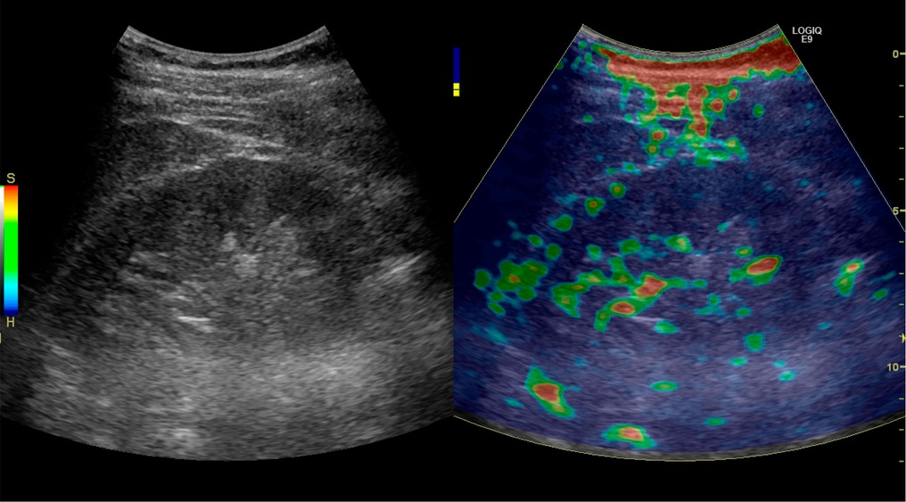 elastography