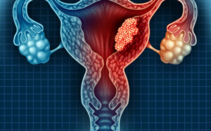 Cervical Cancer Diagnosis: New Minimally-Invasive Screening