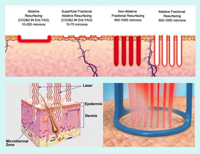 ablative and non-ablative fractional laser scar treatment