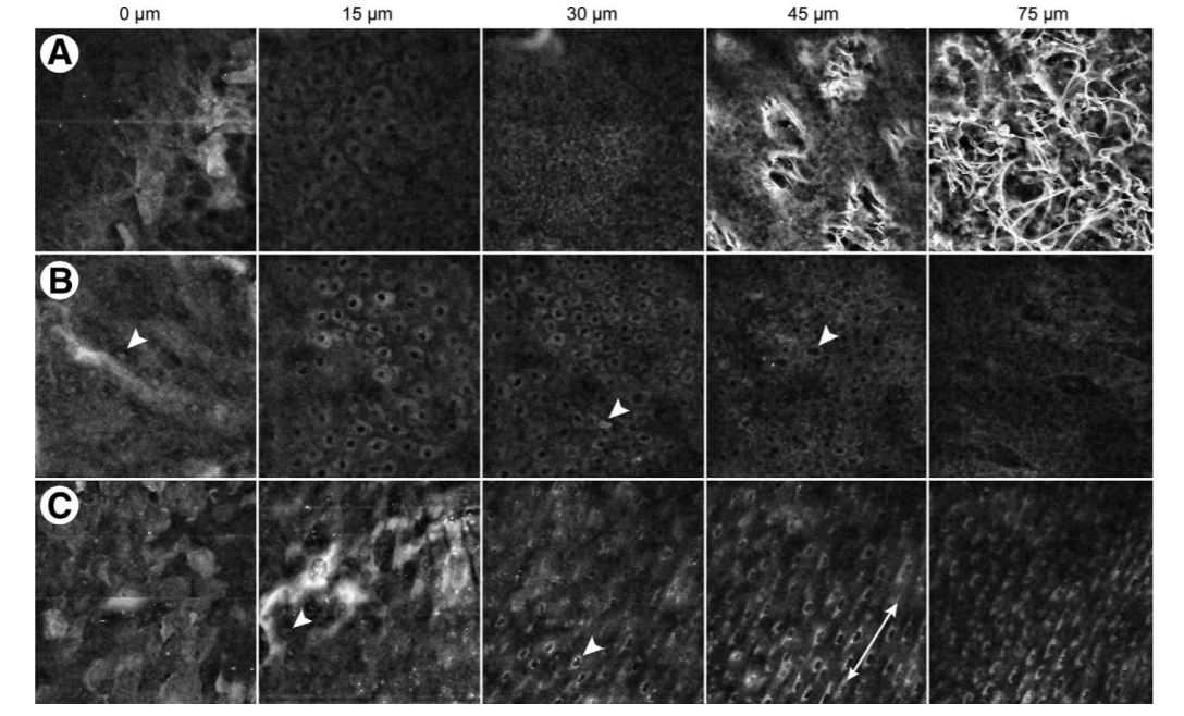 two-photon microscopy diagnosing skin cancer