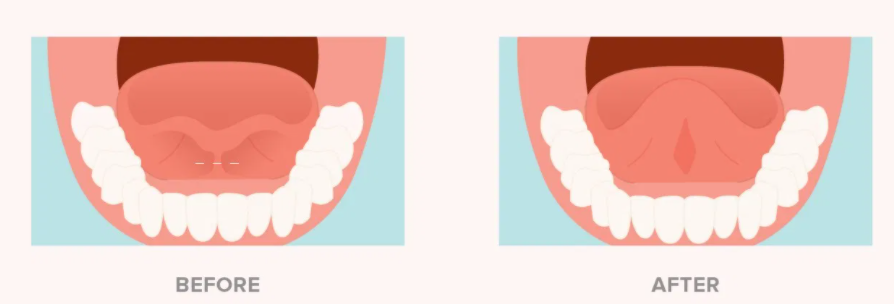 A tied tongue, or a thick area under the tongue, pre and post surgery. The layer of connecting skin was removed. Diode lasers may make these surgeries safer.