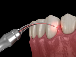 Lasers In Dental Surgeries: A Replacement for Drills?