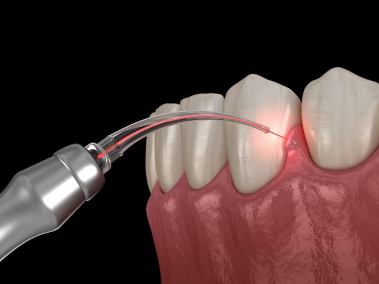 A diode laser cutting into the lower gums, between the teeth