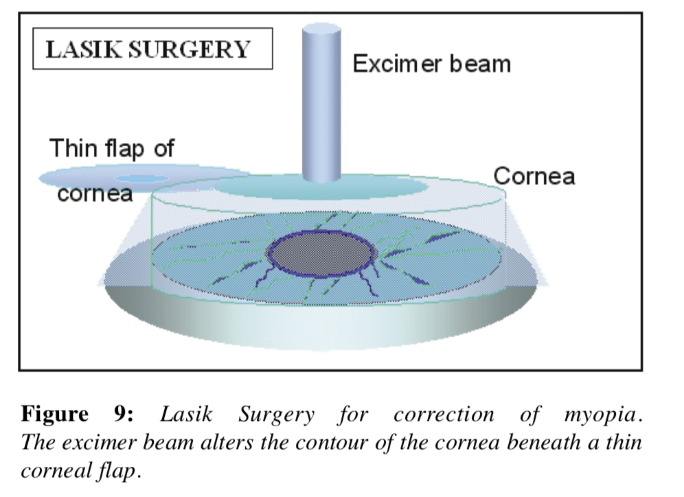 LASIK for opthalmology