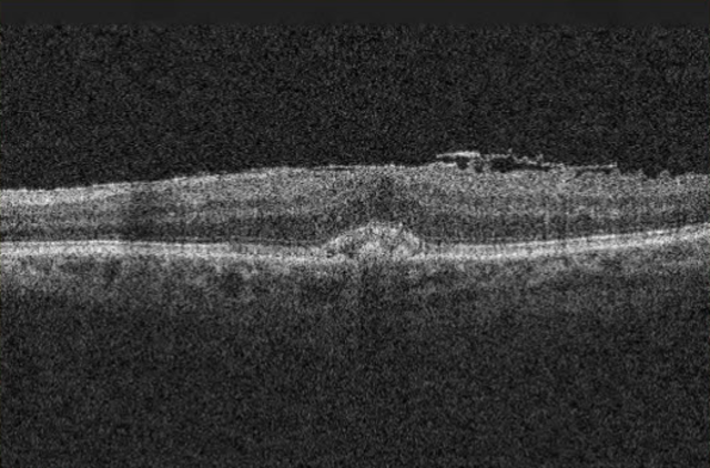 OCT in ophthalmology