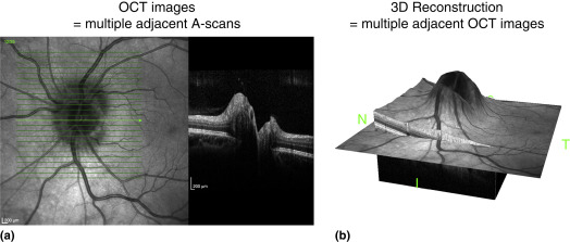 Optical Coherence Tomography 