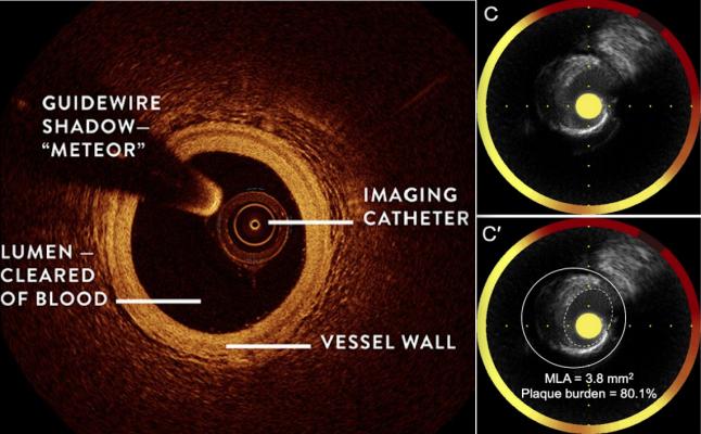 Near infrared spectroscopy enables intravascular imaging