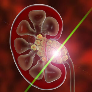 Laser Lithotripsy: Laser Treatment of Kidney Stones