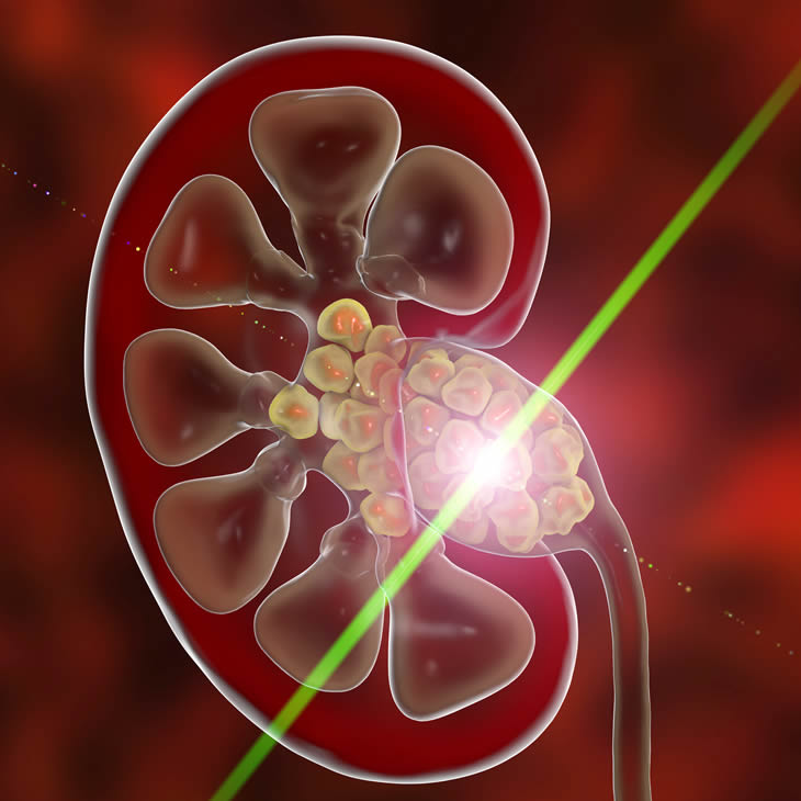 Laser Lithotripsy Laser Treatment of Kidney Stones