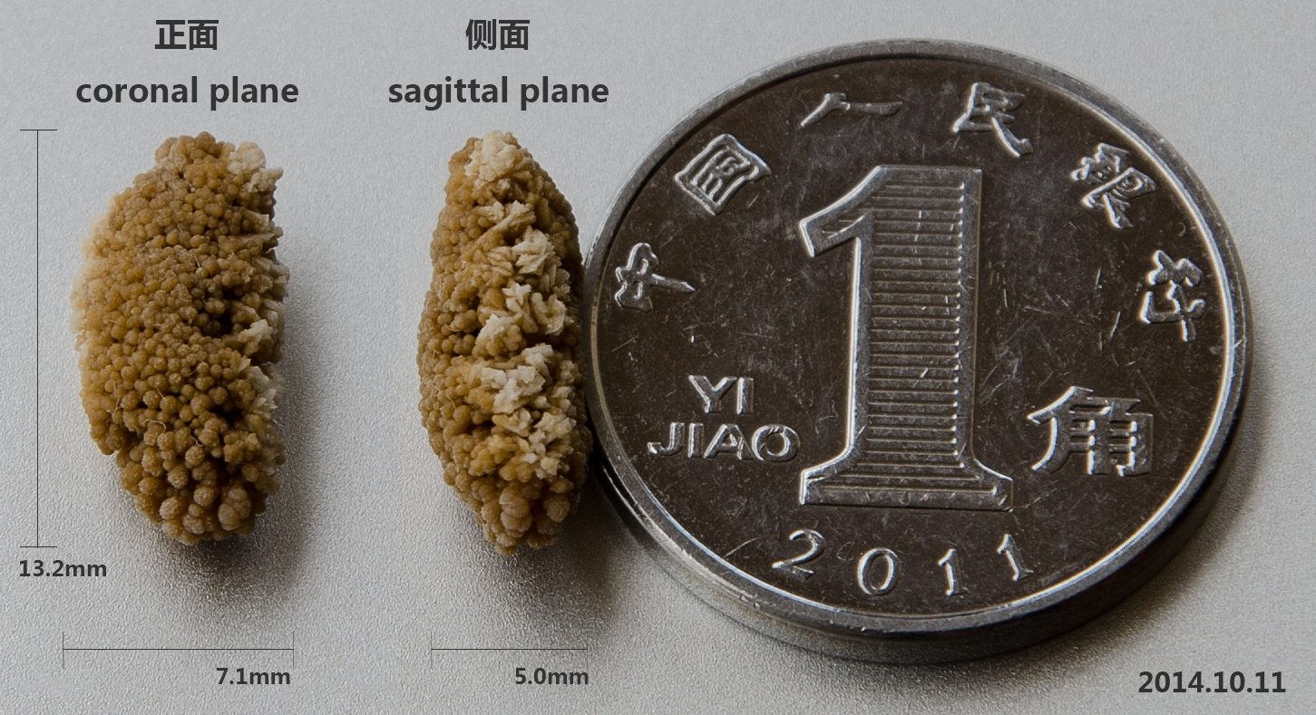 Example of a kidney stone that could be destroyed by a laser.